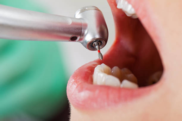 Best Emergency Treatment for Dental Infections or Abscesses in New Baltimore, OH